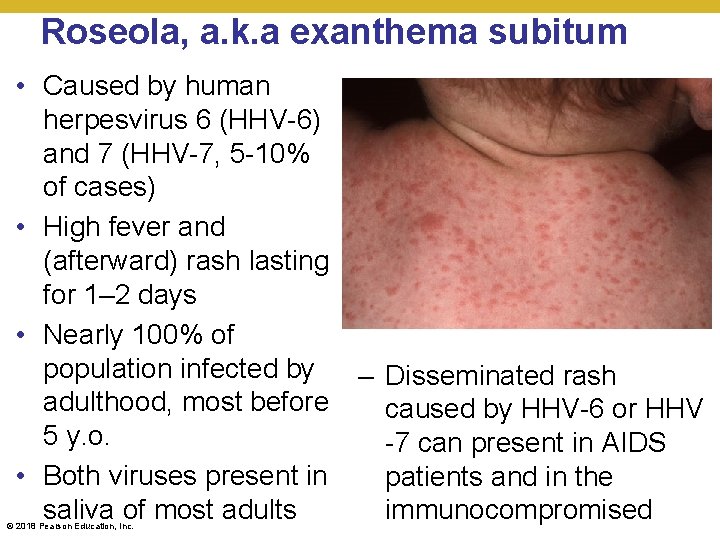Roseola, a. k. a exanthema subitum • Caused by human herpesvirus 6 (HHV-6) and