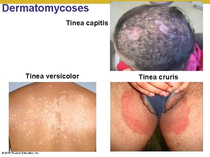 Dermatomycoses Tinea capitis Tinea versicolor © 2018 Pearson Education, Inc. Tinea cruris 