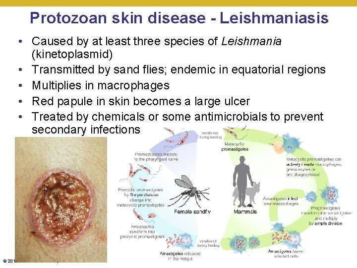 Protozoan skin disease - Leishmaniasis • Caused by at least three species of Leishmania