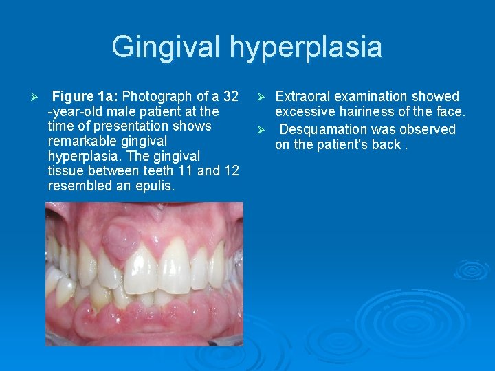 Gingival hyperplasia Ø Figure 1 a: Photograph of a 32 -year-old male patient at