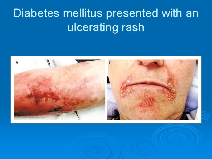 Diabetes mellitus presented with an ulcerating rash 