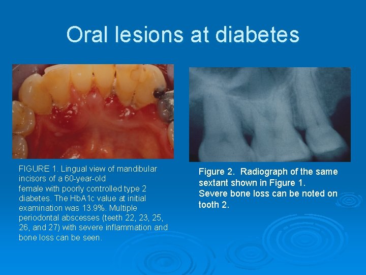 Oral lesions at diabetes FIGURE 1. Lingual view of mandibular incisors of a 60
