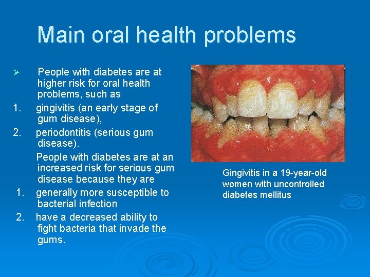 Main oral health problems Ø 1. 2. People with diabetes are at higher risk