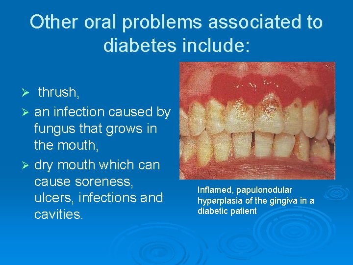 Other oral problems associated to diabetes include: thrush, Ø an infection caused by fungus