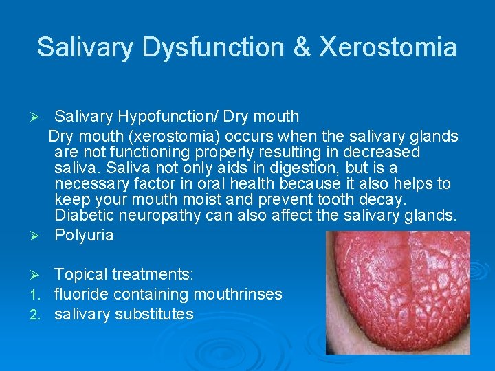 Salivary Dysfunction & Xerostomia Salivary Hypofunction/ Dry mouth (xerostomia) occurs when the salivary glands