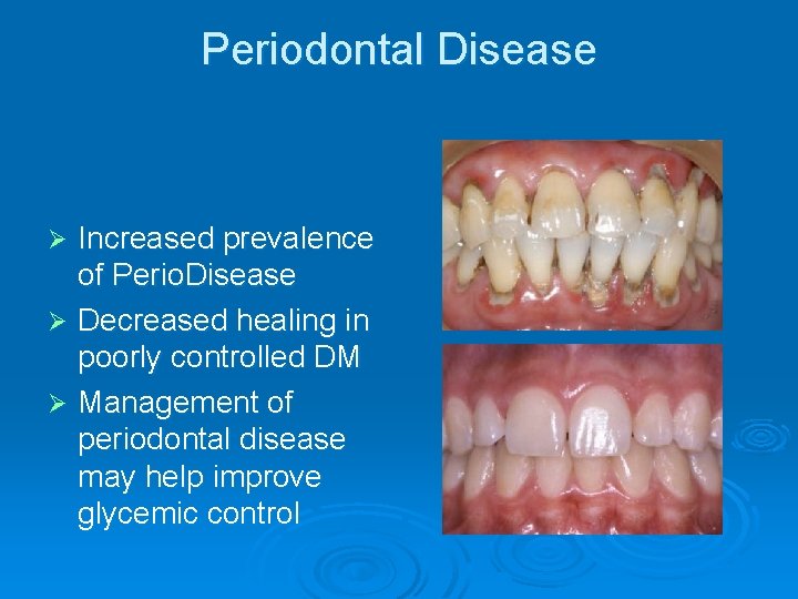 Periodontal Disease Increased prevalence of Perio. Disease Ø Decreased healing in poorly controlled DM