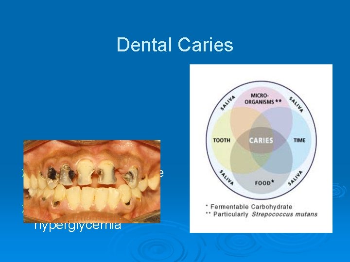 Dental Caries Increased prevalence of dental caries Ø Salivary hyperglycemia Ø 