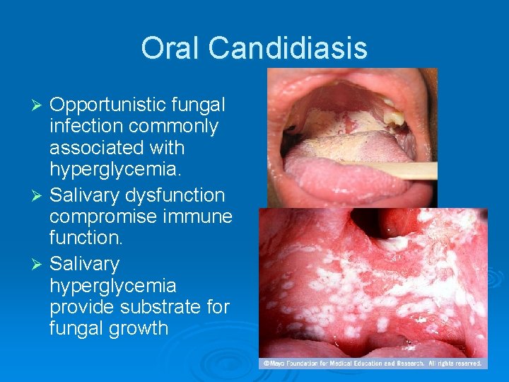 Oral Candidiasis Opportunistic fungal infection commonly associated with hyperglycemia. Ø Salivary dysfunction compromise immune