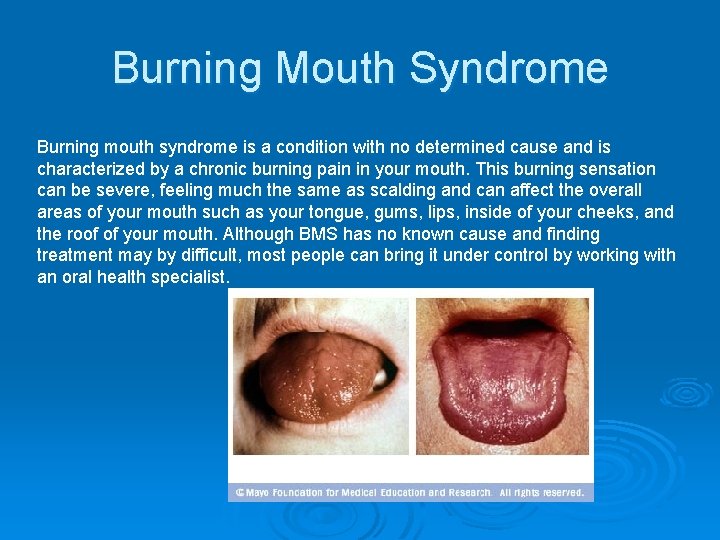 Burning Mouth Syndrome Burning mouth syndrome is a condition with no determined cause and