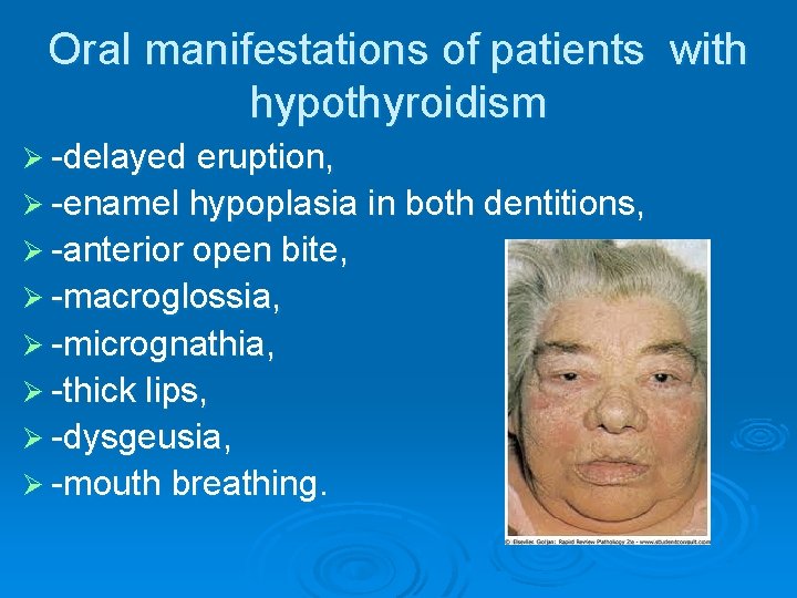 Oral manifestations of patients with hypothyroidism Ø -delayed eruption, Ø -enamel hypoplasia in both