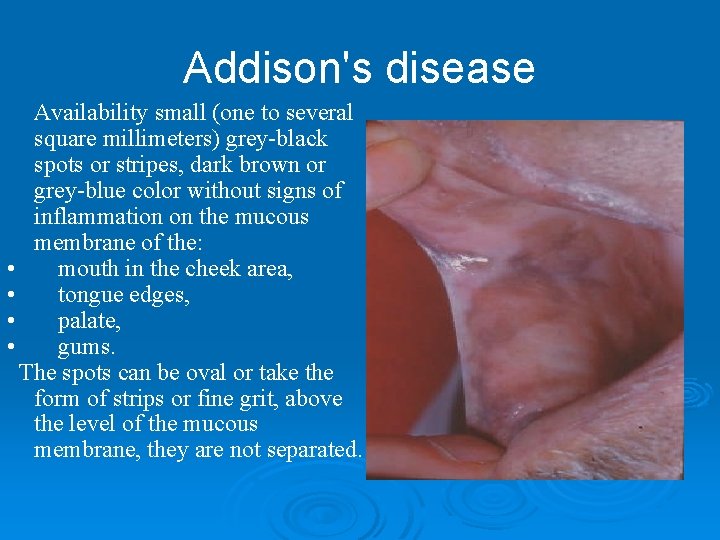 Addison's disease Availability small (one to several square millimeters) grey-black spots or stripes, dark