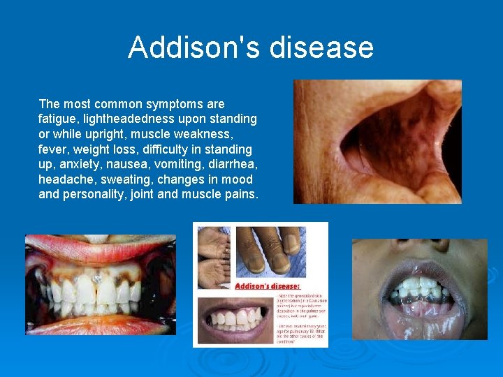 Addison's disease The most common symptoms are fatigue, lightheadedness upon standing or while upright,