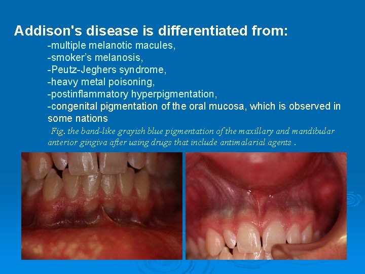 Addison's disease is differentiated from: -multiple melanotic macules, -smoker’s melanosis, -Peutz-Jeghers syndrome, -heavy metal