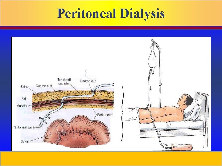Peritoneal Dialysis Prepared by D. Chaplin 