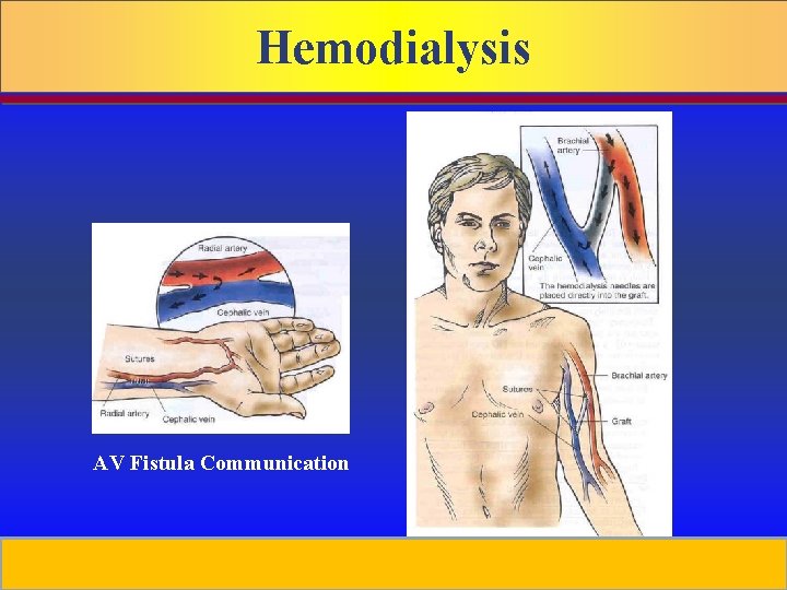 Hemodialysis AV Fistula Communication Prepared by D. Chaplin AV Graph Access 