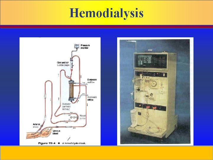 Hemodialysis Circuit Prepared by D. Chaplin Hemodialysis Machine 
