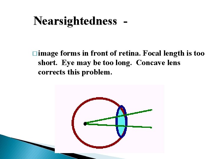 Nearsightedness � image forms in front of retina. Focal length is too short. Eye