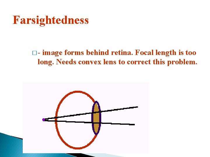 Farsightedness �- image forms behind retina. Focal length is too long. Needs convex lens