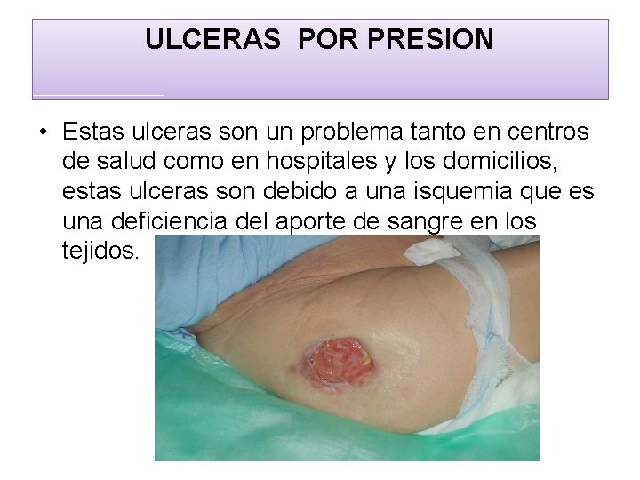 ULCERAS POR PRESION • Estas ulceras son un problema tanto en centros de salud
