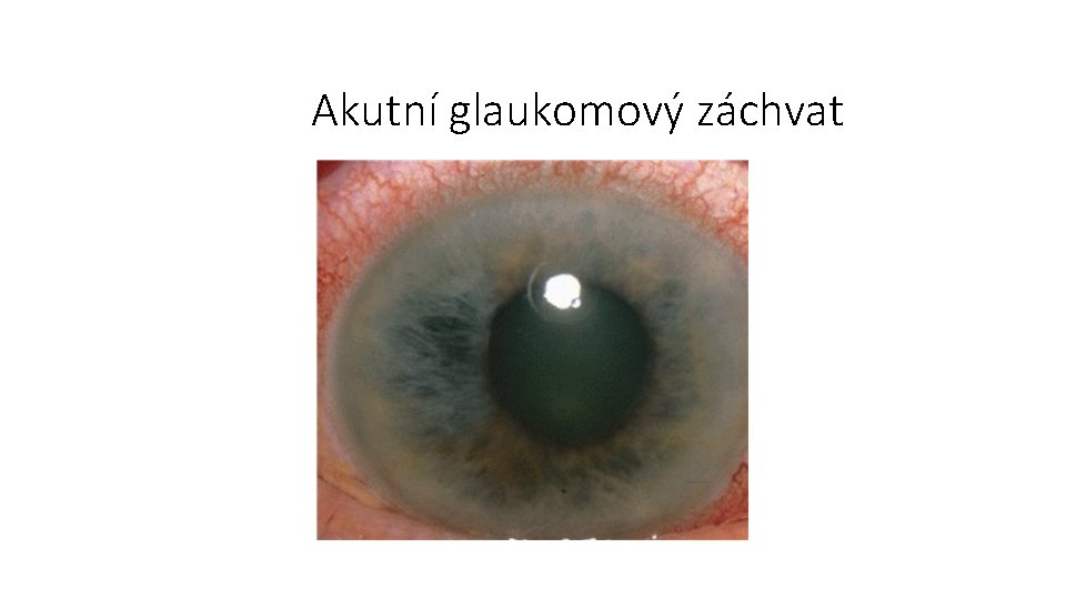 Akutní glaukomový záchvat 