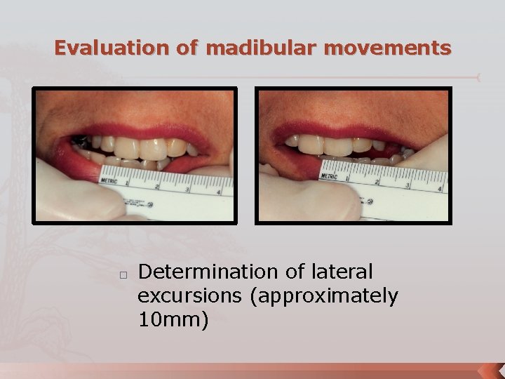 Evaluation of madibular movements � Determination of lateral excursions (approximately 10 mm) 