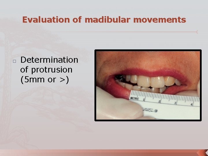 Evaluation of madibular movements � Determination of protrusion (5 mm or >) 