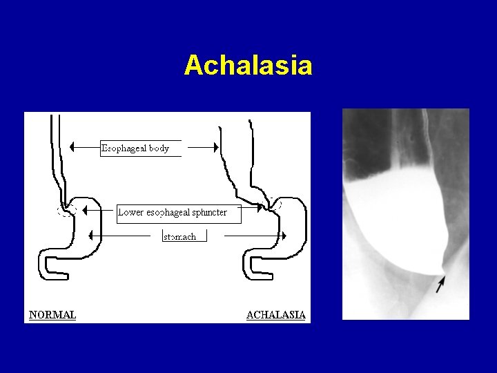 Achalasia 