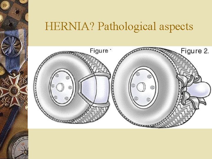 HERNIA? Pathological aspects 