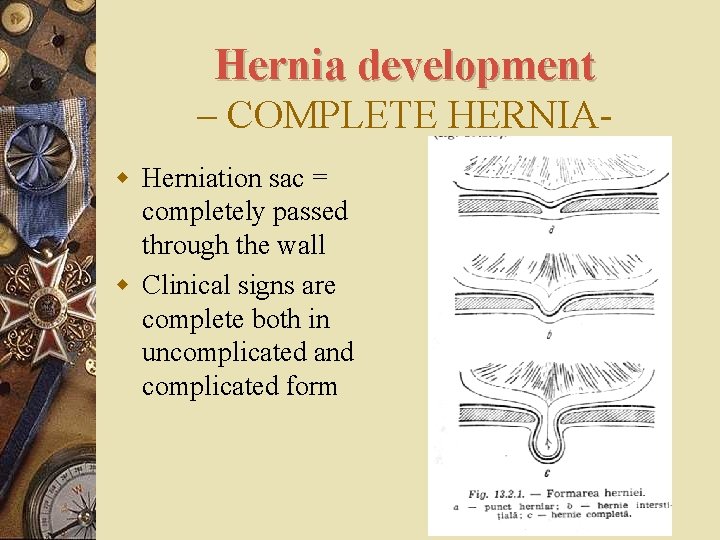 Hernia development – COMPLETE HERNIAw Herniation sac = completely passed through the wall w
