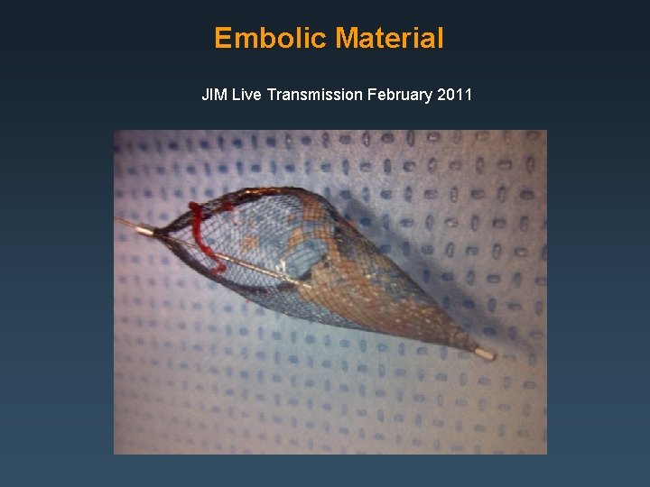 Embolic Material JIM Live Transmission February 2011 