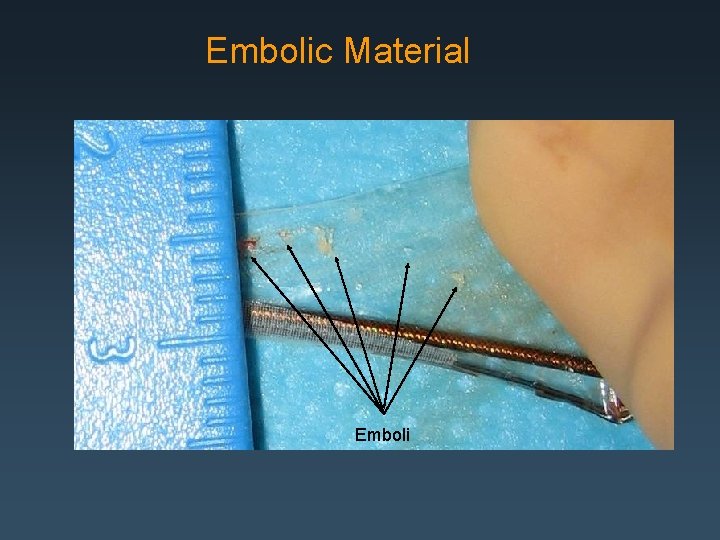Embolic Material Emboli 