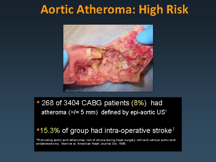 Aortic Atheroma: High Risk • 268 of 3404 CABG patients (8%) had atheroma (>/=