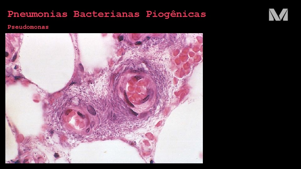 Pneumonias Bacterianas Piogênicas Pseudomonas 