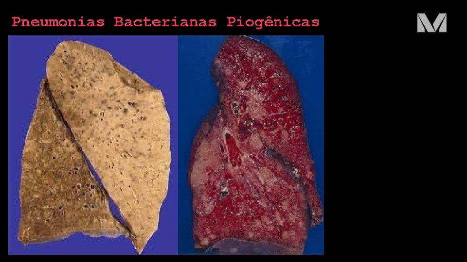 Pneumonias Bacterianas Piogênicas 