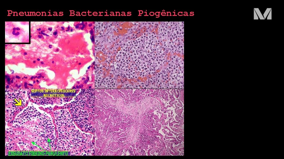 Pneumonias Bacterianas Piogênicas 
