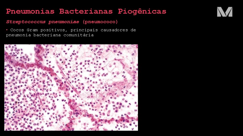 Pneumonias Bacterianas Piogênicas Streptococcus pneumoniae (pneumococo) • Cocos Gram positivos, principais causadores de pneumonia