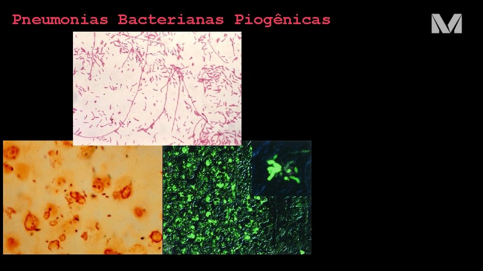 Pneumonias Bacterianas Piogênicas 