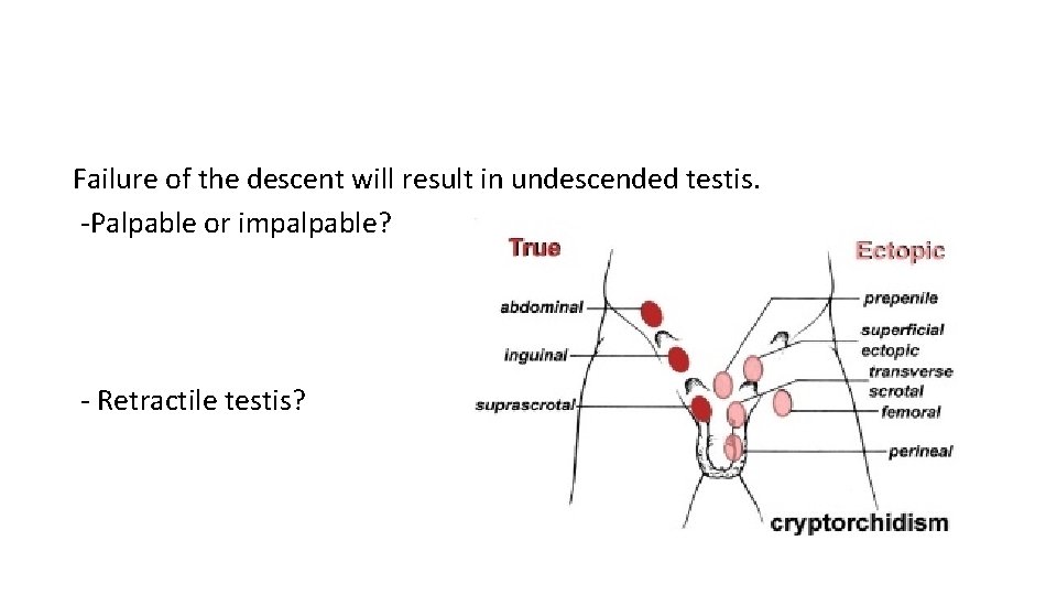 Failure of the descent will result in undescended testis. -Palpable or impalpable? - Retractile