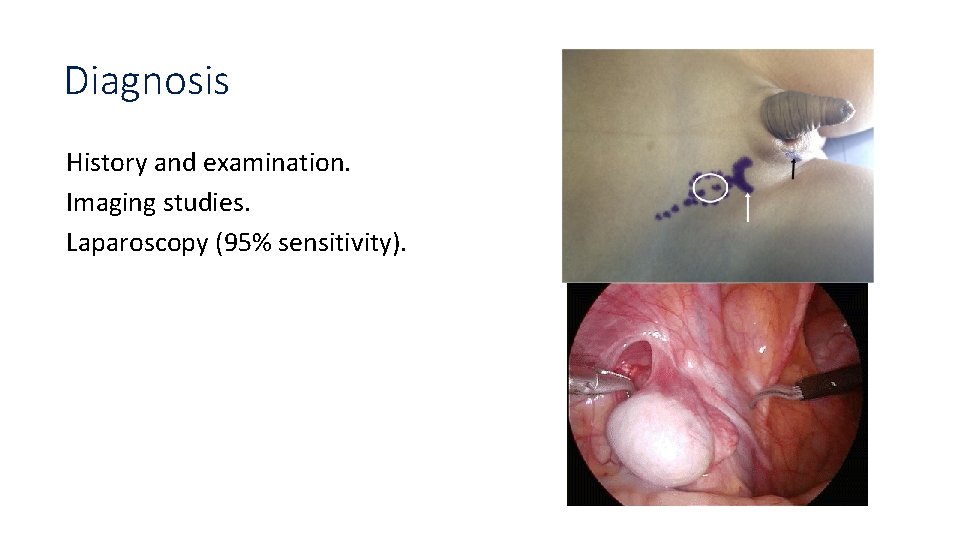 Diagnosis History and examination. Imaging studies. Laparoscopy (95% sensitivity). 