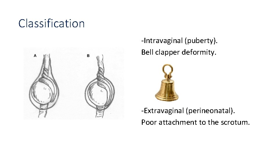 Classification -Intravaginal (puberty). Bell clapper deformity. -Extravaginal (perineonatal). Poor attachment to the scrotum. 