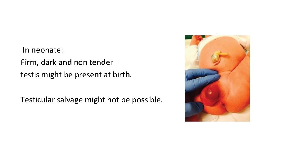 In neonate: Firm, dark and non tender testis might be present at birth. Testicular