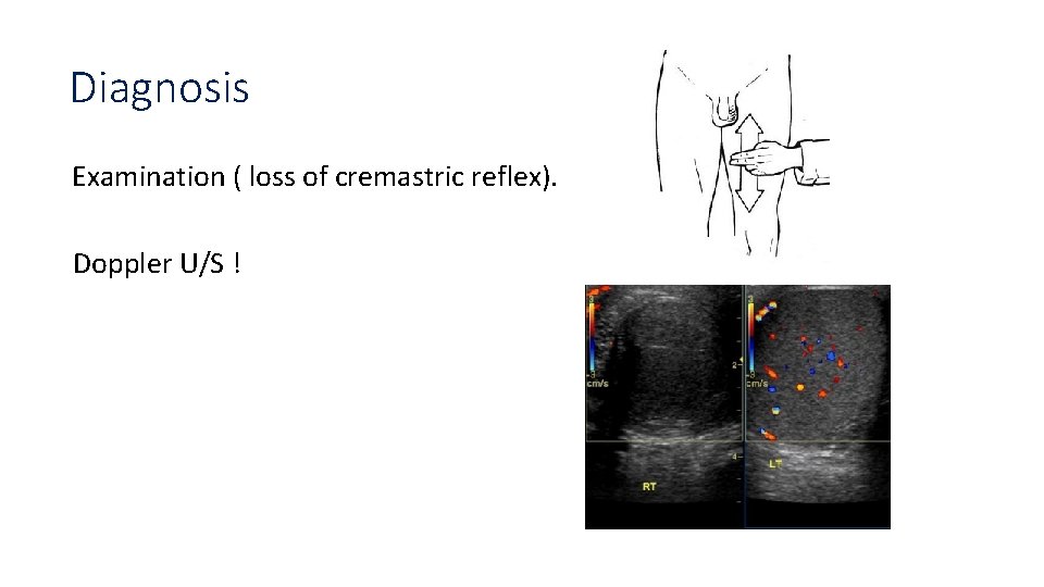 Diagnosis Examination ( loss of cremastric reflex). Doppler U/S ! 