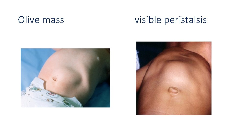 Olive mass visible peristalsis 