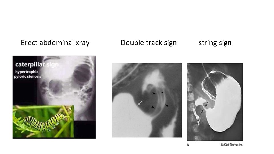 Erect abdominal xray Double track sign string sign 