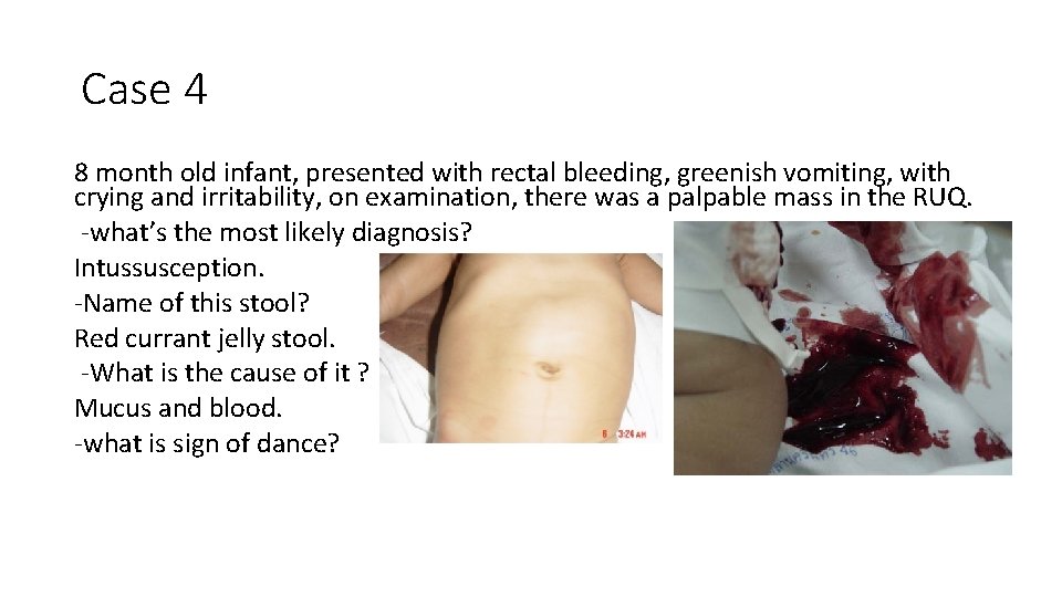 Case 4 8 month old infant, presented with rectal bleeding, greenish vomiting, with crying