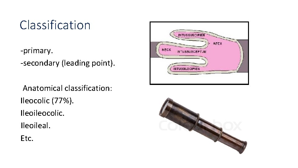 Classification -primary. -secondary (leading point). Anatomical classification: Ileocolic (77%). Ileoileocolic. Ileoileal. Etc. 