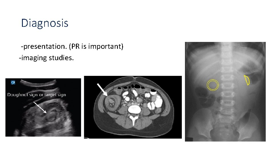 Diagnosis -presentation. (PR is important) -imaging studies. 