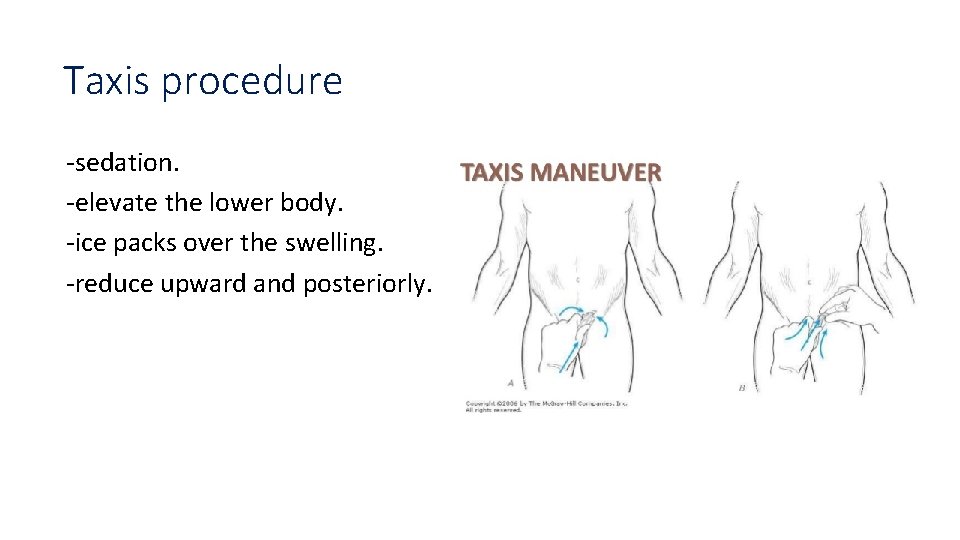 Taxis procedure -sedation. -elevate the lower body. -ice packs over the swelling. -reduce upward