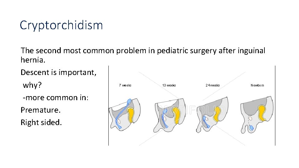 Cryptorchidism The second most common problem in pediatric surgery after inguinal hernia. Descent is