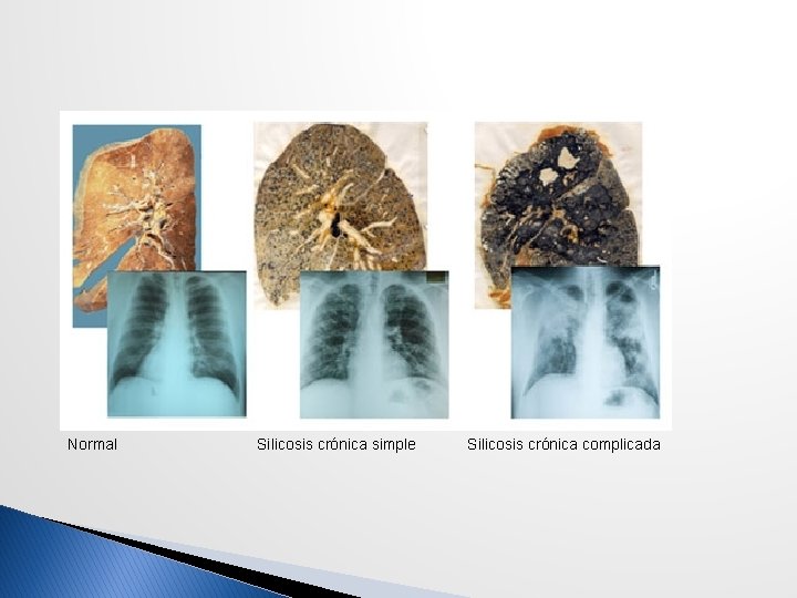 Normal Silicosis crónica simple Silicosis crónica complicada 